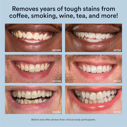 Rapid Teeth Whitening Kit